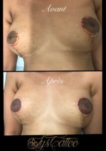 Vous avez subi une mastectomie, une opération du sein, ou vous présentez une asymétrie ou une décoloration de l’aréole mammaire ? Chez Lys Tattoo, nous avons des solutions adaptées pour vous aider à retrouver confiance en votre apparence, à proximité de Villenave d'Ornon et Bègles. La dermopigmentation, également appelée tatouage médical, est une technique de médecine esthétique non invasive semblable au tatouage. Elle consiste à introduire des pigments dans le derme à l’aide d’un appareil électrique spécialement conçu pour cette pratique. Cette technique permet de modifier la couleur d’une zone de peau définie, que ce soit pour des raisons réparatrices ou purement esthétiques à Gradignan proche de Bordeaux et du bassin d'Arcachon en Gironde.