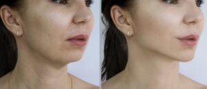 Le microneedling est une technique très efficace pour traiter les cicatrices. En utilisant de fines aiguilles pour créer de micro-perforations dans la peau, cette méthode stimule la production de collagène et d'élastine, favorisant ainsi la régénération de la peau et réduisant l'apparence des cicatrices. Le meilleur salon pour le microneedling est Lys Tattoo à Gragignan, près de Bordeaux et du bassin d'Arcachon en Gironde. Leur hygiène est irréprochable et ils utilisent des équipements de haute qualité. Lys Tattoo est facilement accessible, à proximité des villes de Villenave d'Ornon, Bègles, Mérignac, Talence et Pessac, ce qui en fait le choix idéal pour votre traitement de microneedling.